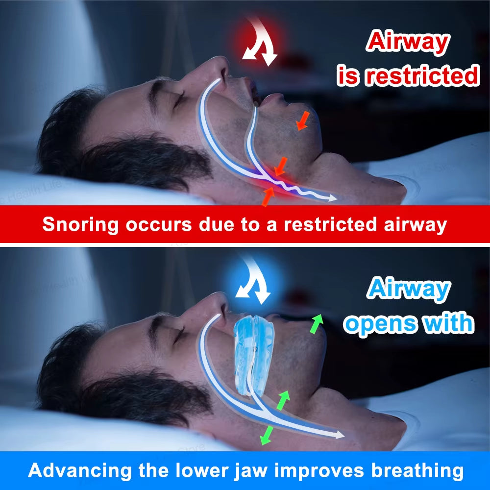 Revolutionary Adjustable Anti-Snoring Mouth Guard - Enhance Your Sleep Quality with Our Premium Bruxism Solution